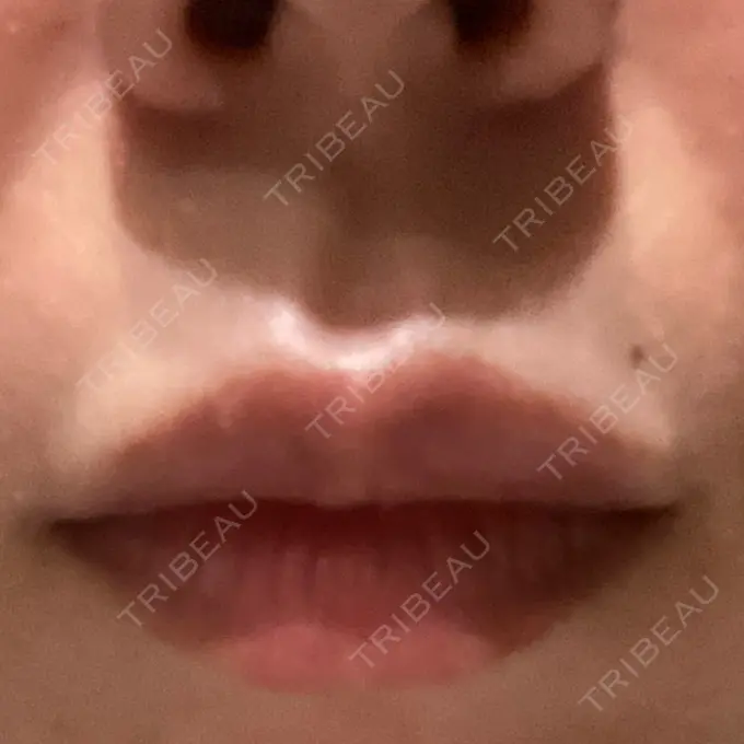 ボトックス（人中） veary clinic AFTER メイン用