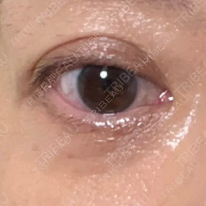 下まぶたの脂肪取り 東京イセアクリニック DAY 51 メイン用