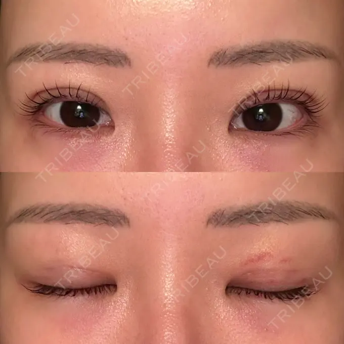 二重埋没 品川スキンクリニック 宇都宮院（※品川美容外科提携） DAY 7 メイン用