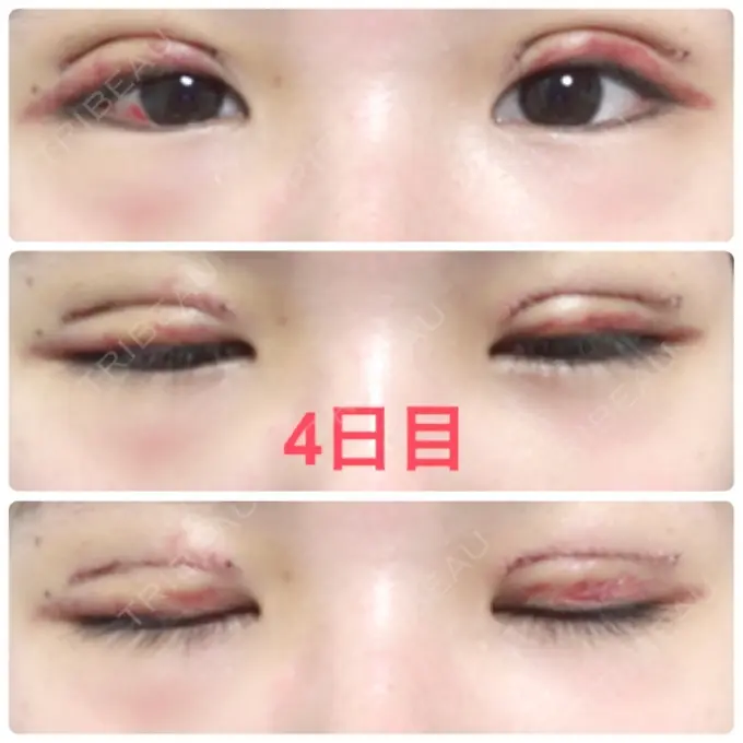 二重切開 品川スキンクリニック広島院 DAY 4 メイン用
