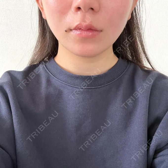 糸リフト / その他（輪郭） 東京シンデレラ美容外科 池袋院 AFTER メイン用