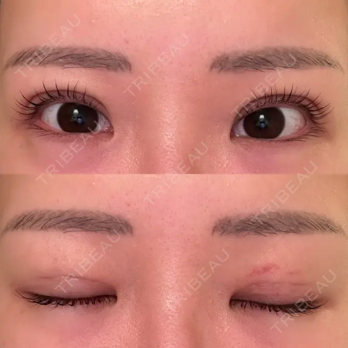 二重埋没 品川スキンクリニック 宇都宮院（※品川美容外科提携） DAY 8 メイン用