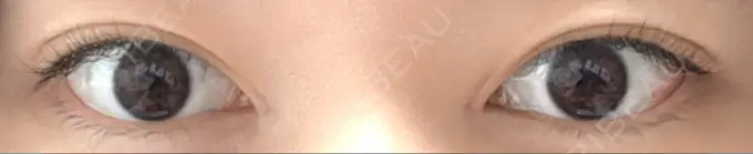 目頭切開 東京シンデレラ美容外科 池袋院 DAY 7 メイン用