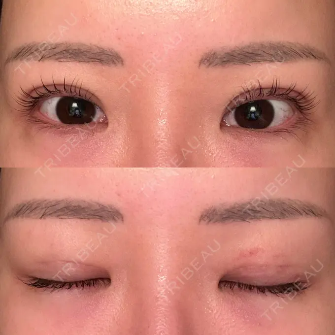 二重埋没 品川スキンクリニック 宇都宮院（※品川美容外科提携） DAY 9 メイン用