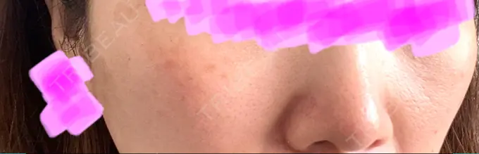 ピコレーザートーニング（美白・肝斑） アモーレクリニック 名古屋院 DAY 2 メイン用