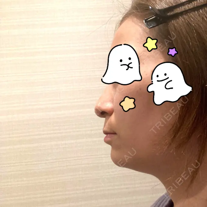 ヒアルロン酸注入（涙袋） / ヒアルロン酸注入（あご） 共立美容外科 梅田院 DAY 0 メイン用