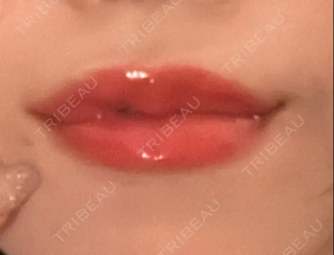 ヒアルロン酸注入（唇） フィラークリニック 新宿院 AFTER メイン用