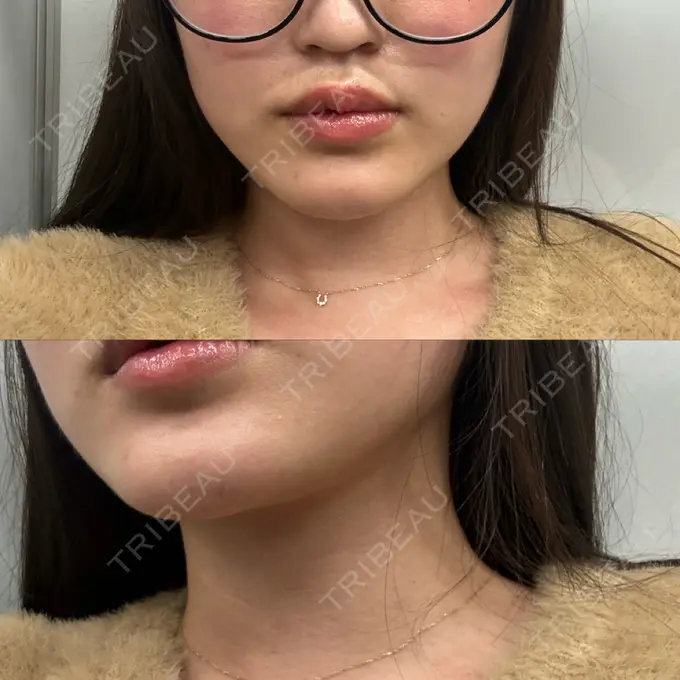 糸リフト / 脂肪吸引（顔） Casa de GRACIA GINZA 【カーサデグラシアギンザ】 DAY 47 メイン用