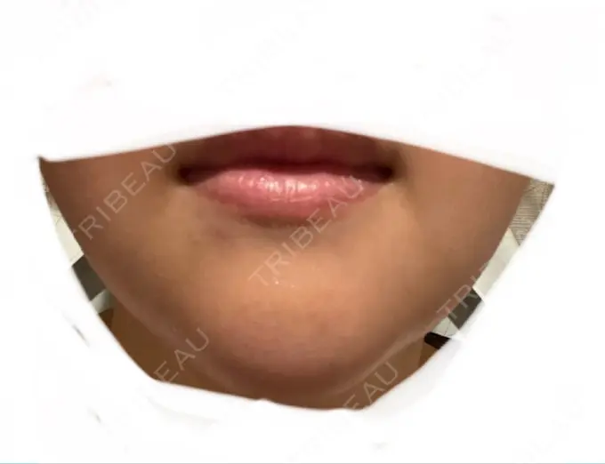 あごプロテーゼ ルラ美容クリニック 渋谷本院 DAY 1 メイン用