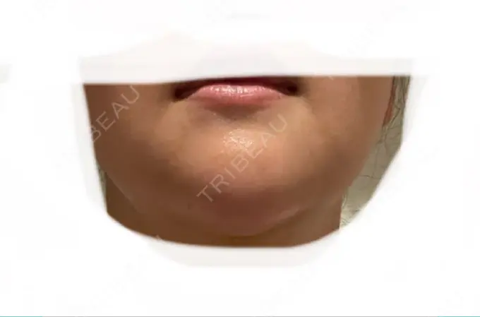 あごプロテーゼ ルラ美容クリニック 渋谷本院 DAY 3 メイン用