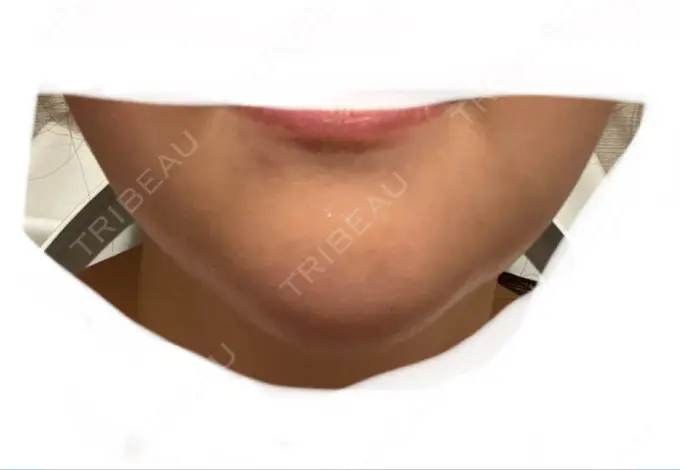 あごプロテーゼ ルラ美容クリニック 渋谷本院 DAY 3 メイン用