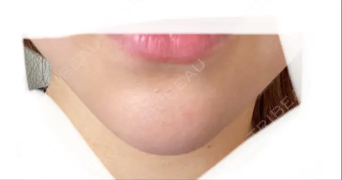 あごプロテーゼ ルラ美容クリニック 渋谷本院 DAY 30 メイン用