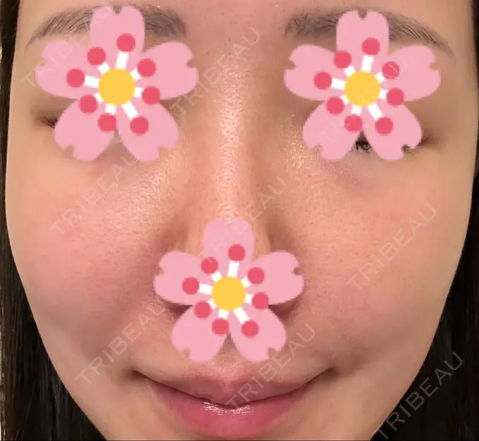 ヒアルロン酸注入（頬） 湘南美容クリニック 宇都宮院 AFTER メイン用