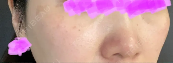 ピコレーザートーニング（美白・肝斑） アモーレクリニック 名古屋院 DAY 2 メイン用