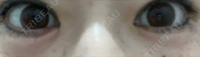 ヒアルロン酸注入（涙袋） / ヒアルロン酸注入（あご） 共立美容外科 梅田院 DAY 1 メイン用