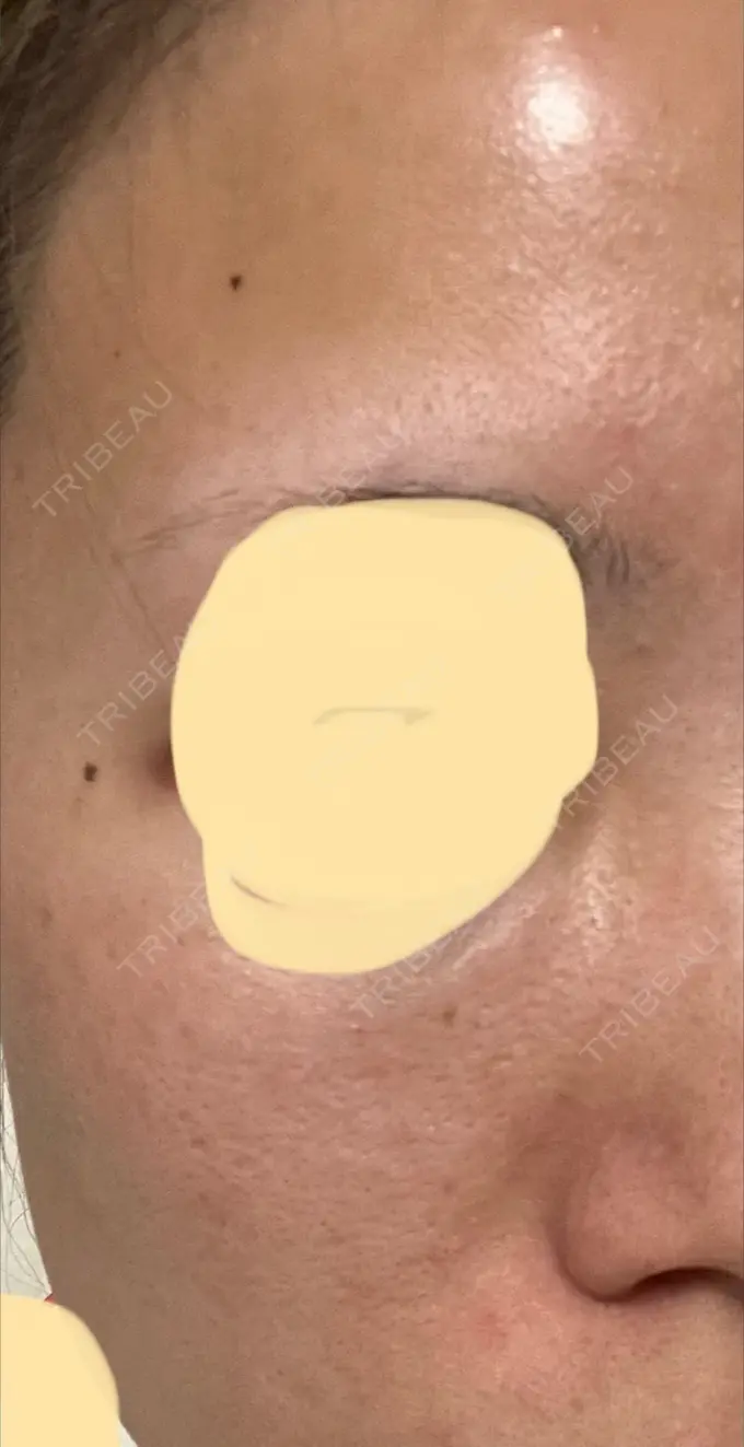 イオン導入 / ルメッカ ルラ美容クリニック 大宮院 / ルラスキンクリニック 大宮院 DAY 3 メイン用