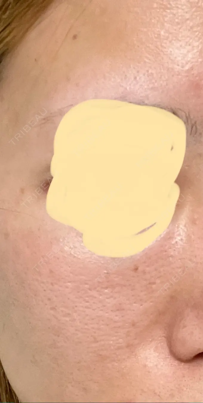 イオン導入 / ルメッカ ルラ美容クリニック 大宮院 / ルラスキンクリニック 大宮院 AFTER メイン用