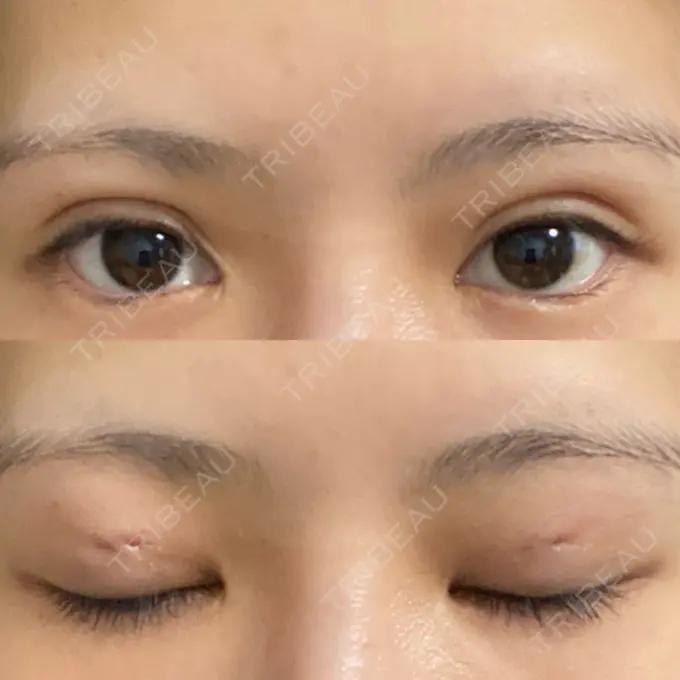 二重埋没 日本ウェルネス再生クリニック DAY 0 メイン用