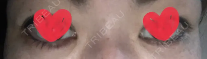 ヒアルロン酸注入（涙袋） / ヒアルロン酸注入（あご） 共立美容外科 梅田院 AFTER メイン用