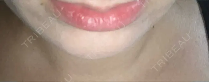 ヒアルロン酸注入（涙袋） / ヒアルロン酸注入（あご） 共立美容外科 梅田院 DAY 2 メイン用