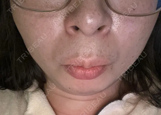 脂肪吸引注射（顔） 東京たかはしクリニック 練馬院 AFTER メイン用