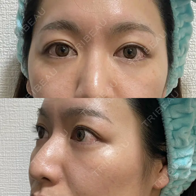 クマ治療 吉井クリニック DAY 181 メイン用