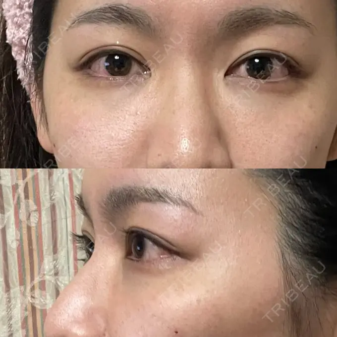 クマ治療 吉井クリニック DAY 182 メイン用