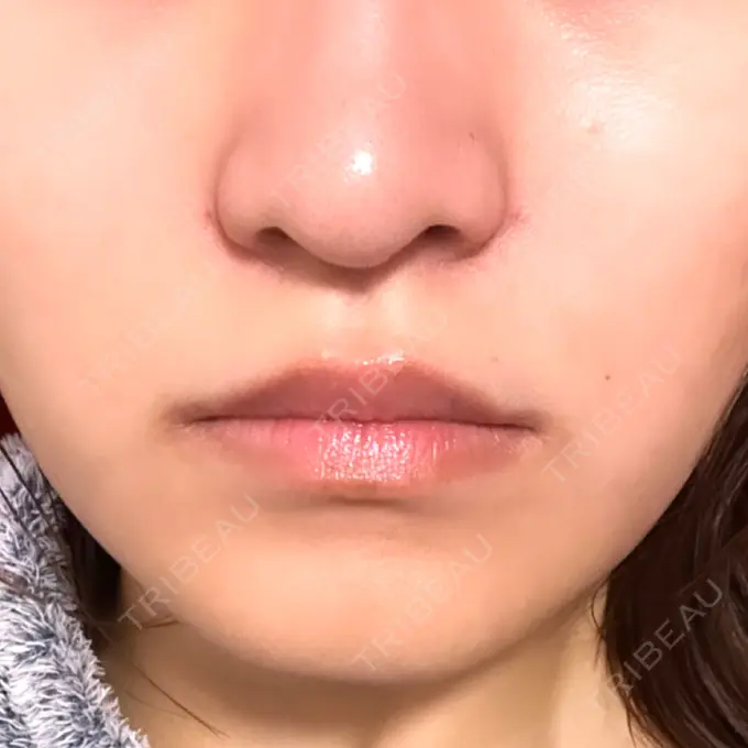 ヒアルロン酸注入（鼻翼基部） 豊洲内科・糖尿病 / 形成・美容外科クリニック DAY 1 メイン用