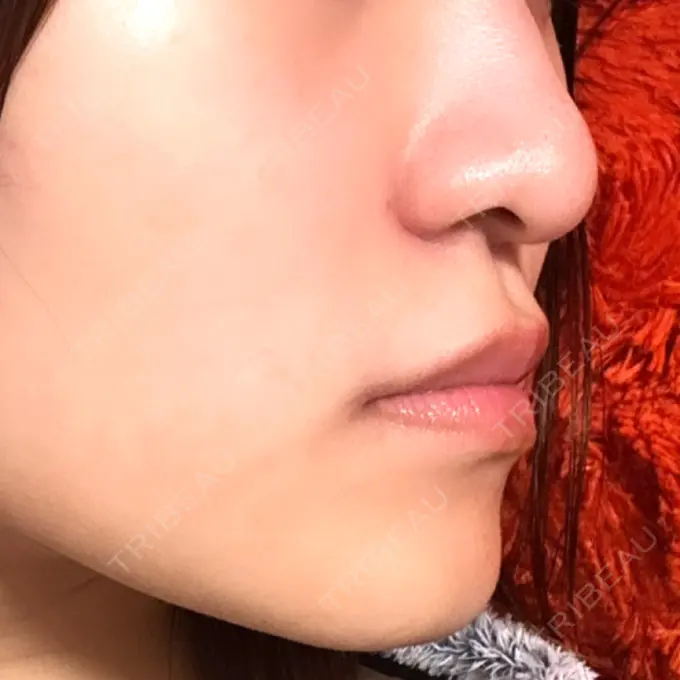 ヒアルロン酸注入（鼻翼基部） 豊洲内科・糖尿病 / 形成・美容外科クリニック DAY 1 メイン用