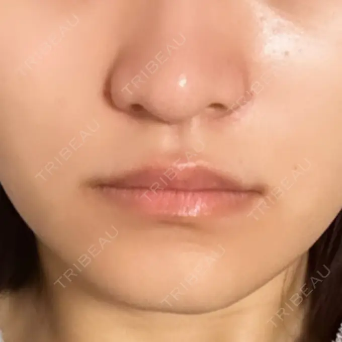 ヒアルロン酸注入（鼻翼基部） 豊洲内科・糖尿病 / 形成・美容外科クリニック DAY 1 メイン用