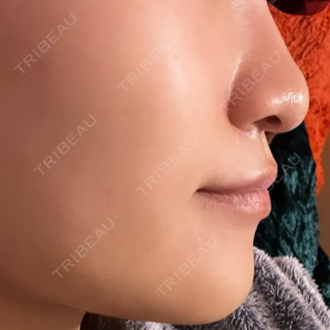 ヒアルロン酸注入（鼻翼基部） 豊洲内科・糖尿病 / 形成・美容外科クリニック DAY 1 メイン用