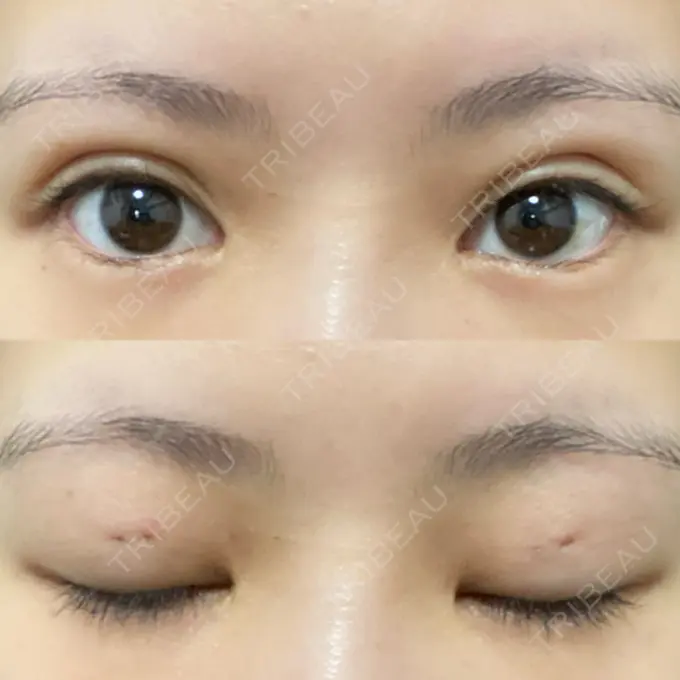 二重埋没 日本ウェルネス再生クリニック DAY 1 メイン用