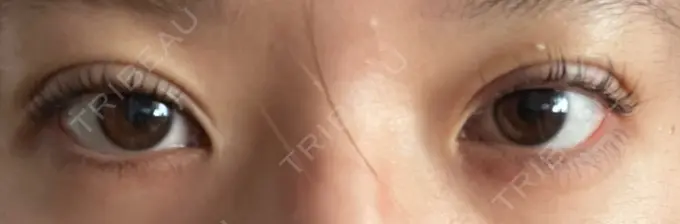 二重埋没 / ハイフ（顔） 日本ウェルネス再生クリニック DAY 1 メイン用