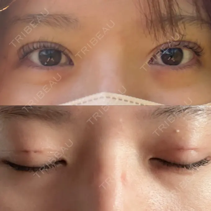 二重埋没 / ハイフ（顔） 日本ウェルネス再生クリニック DAY 0 メイン用