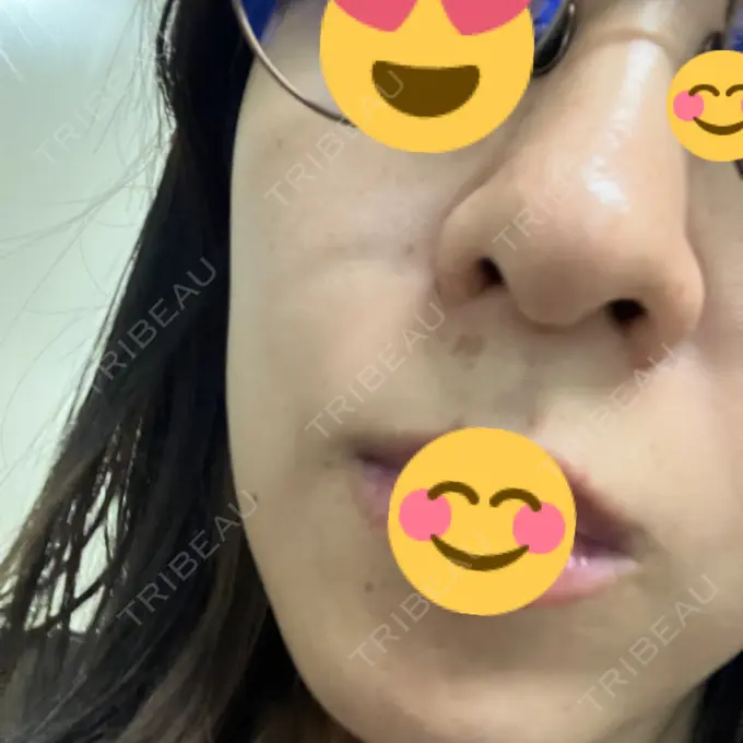 ピーリング（ハリ・ツヤ） MYCLINIC 西新宿 AFTER メイン用