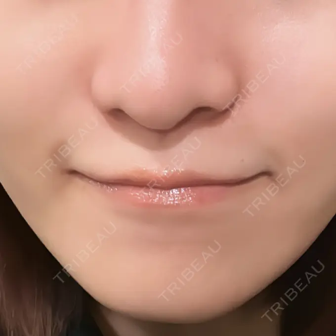 ヒアルロン酸注入（鼻翼基部） 豊洲内科・糖尿病 / 形成・美容外科クリニック DAY 2 メイン用