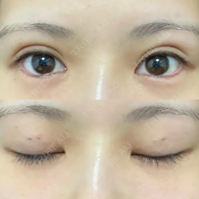 二重埋没 日本ウェルネス再生クリニック DAY 2 メイン用