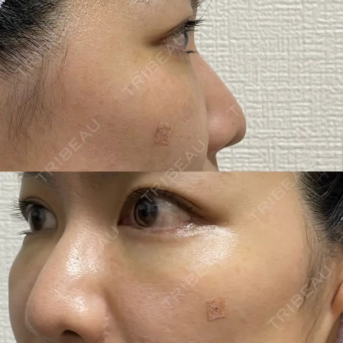 クマ治療 吉井クリニック DAY 184 メイン用