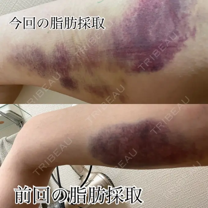 クマ治療 吉井クリニック DAY 184 メイン用