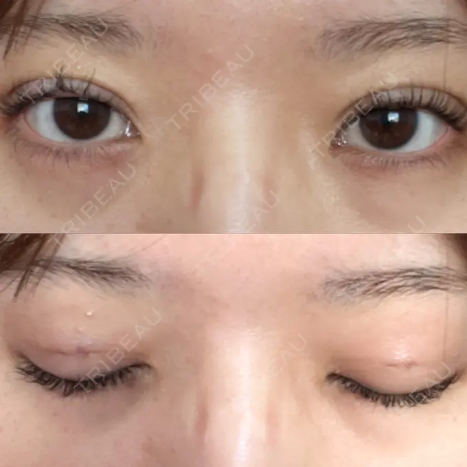 二重埋没 / ハイフ（顔） 日本ウェルネス再生クリニック DAY 2 メイン用