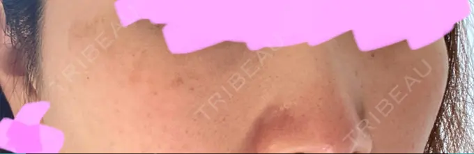 ピコレーザートーニング（美白・肝斑） アモーレクリニック 名古屋院 AFTER メイン用