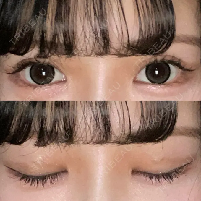 二重埋没 日本ウェルネス再生クリニック DAY 3 メイン用