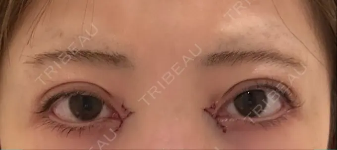 二重埋没 / 目頭切開 AI Beauty Clinic （エーアイ美容クリニック） DAY 0 メイン用