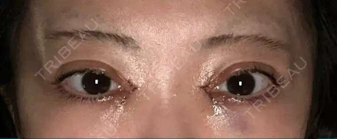 二重埋没 / 目頭切開 AI Beauty Clinic （エーアイ美容クリニック） DAY 1 メイン用