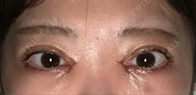 二重埋没 / 目頭切開 AI Beauty Clinic （エーアイ美容クリニック） DAY 2 メイン用