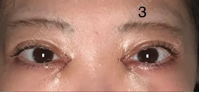 二重埋没 / 目頭切開 AI Beauty Clinic （エーアイ美容クリニック） DAY 3 メイン用