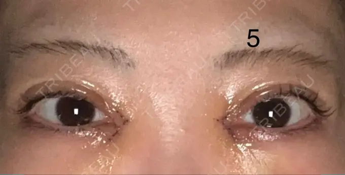 二重埋没 / 目頭切開 AI Beauty Clinic （エーアイ美容クリニック） DAY 5 メイン用