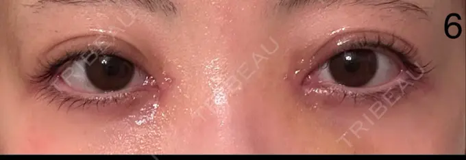 二重埋没 / 目頭切開 AI Beauty Clinic （エーアイ美容クリニック） DAY 6 メイン用