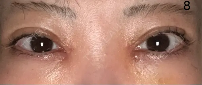 二重埋没 / 目頭切開 AI Beauty Clinic （エーアイ美容クリニック） DAY 8 メイン用