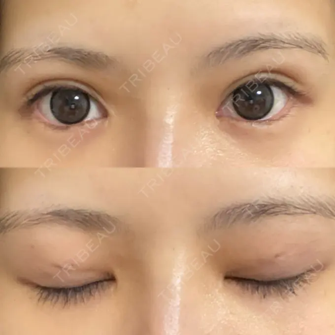 二重埋没 日本ウェルネス再生クリニック DAY 4 メイン用